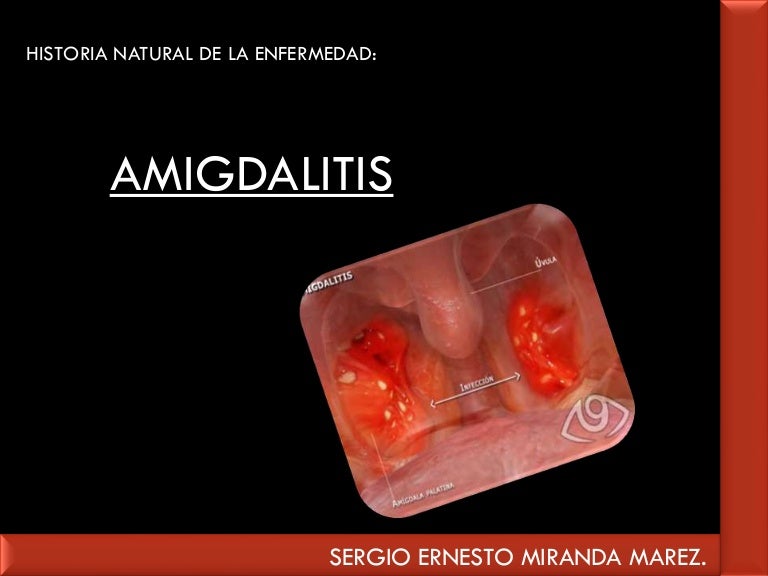 amigdalitis cronica como curar naturalmente