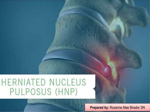 Herniated Nucleus Pulposus (HNP).pptx
