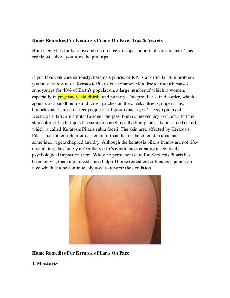 Home Remedies For Keratosis Pilaris On Face Tips & Secrets