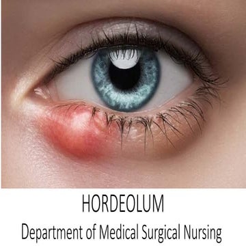 HORDEOLUM & CHALAZION and its management.pptx