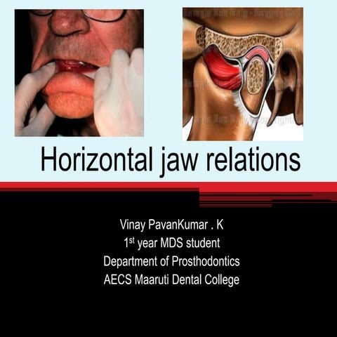 Horizontal jaw relation in complete denture