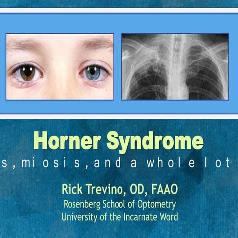 Horner Syndrome