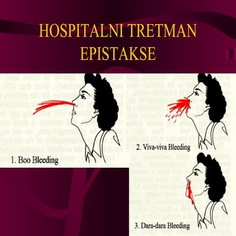 EPISTAXIS: HOSPITAL TREATMENT | PPT