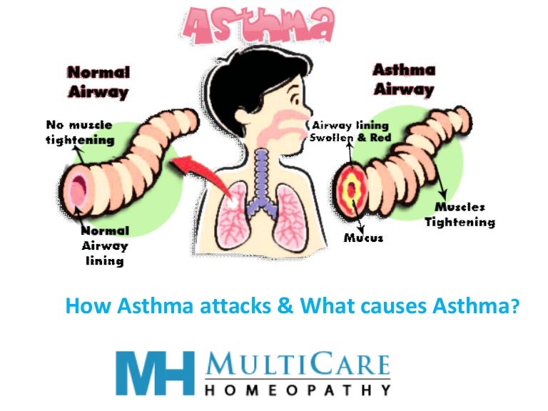 How asthma attacks & what causes asthma