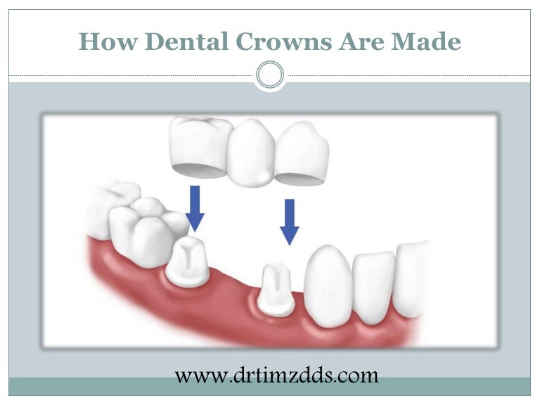 How Dental Crowns Are Made