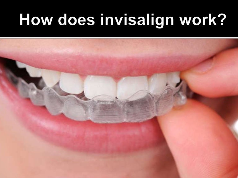 how does invisalign work how does invisalign work