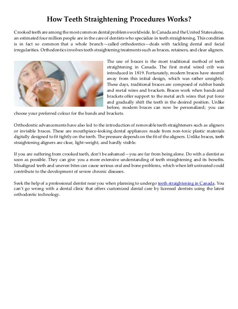 dental straighteners