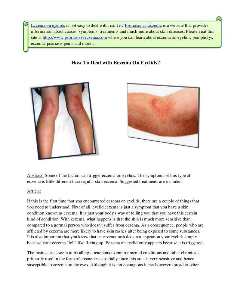 How To Deal with Eczema On Eyelids?