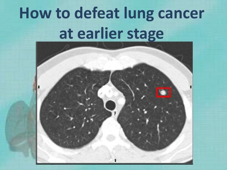 How to defeat lung cancer at earlier stage