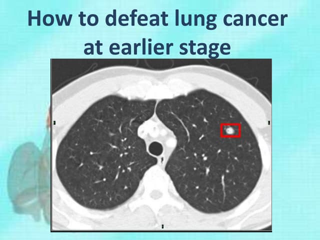 How to defeat lung cancer at earlie...