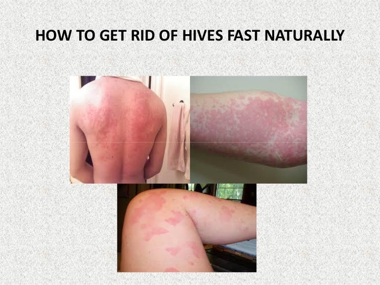 How to get rid of hives fast naturally