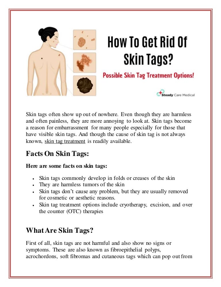 skin tag treatment