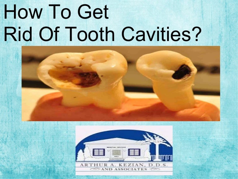 How To Get Rid Of Holes In Teeth Cavity Filling The Procedure