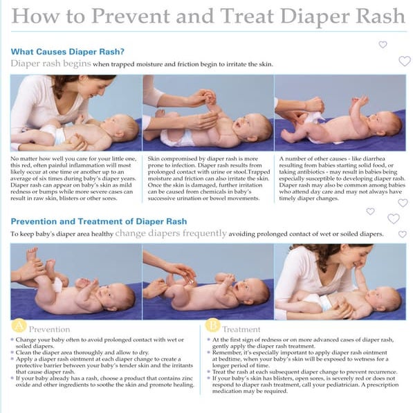 How to Prevent and Treat Diaper Rash | PDF