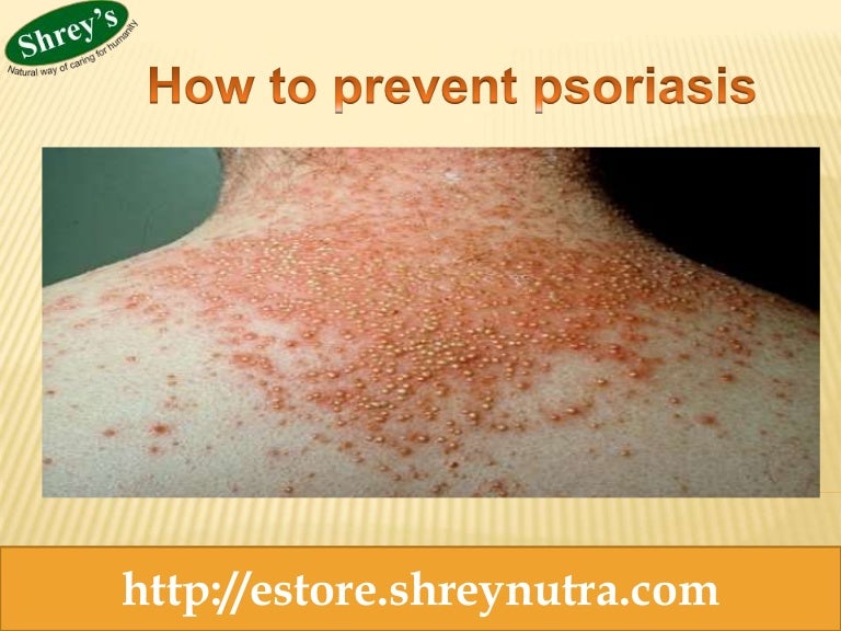 How to prevent psoriasis Ayurvedic Supplement for Psoriasis