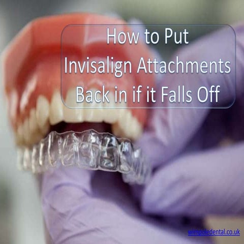 Invisalign Attachments - How to Put It Back in if it Falls Off | PPTX