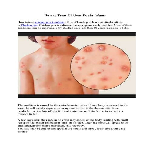 How to treat chicken pox in infants