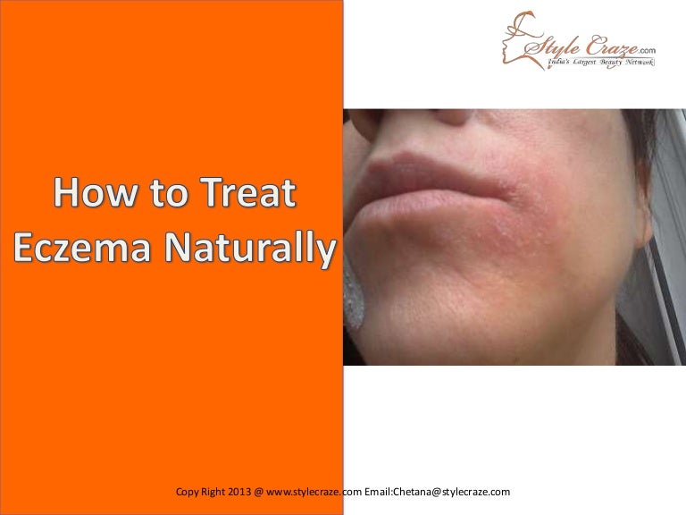 What Can You Use Naturally For Eczema On Face What Can You Use Naturally For Eczema On Face