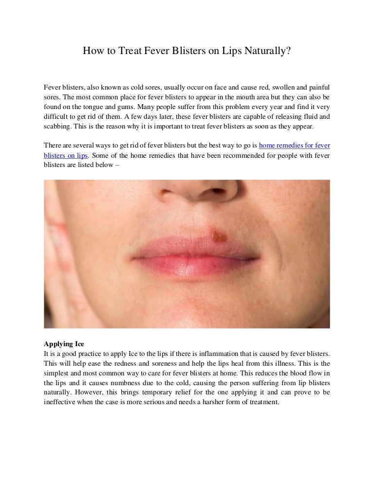 How to treat fever blisters on lips naturally