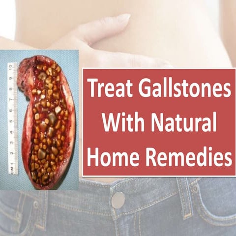 How to treat gallbladder stones with natural remedies