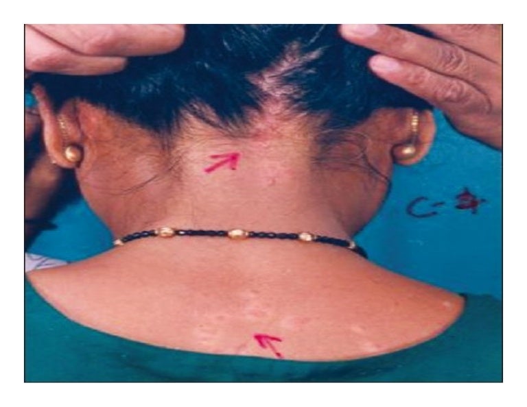 How To Treat Sarcoidosis