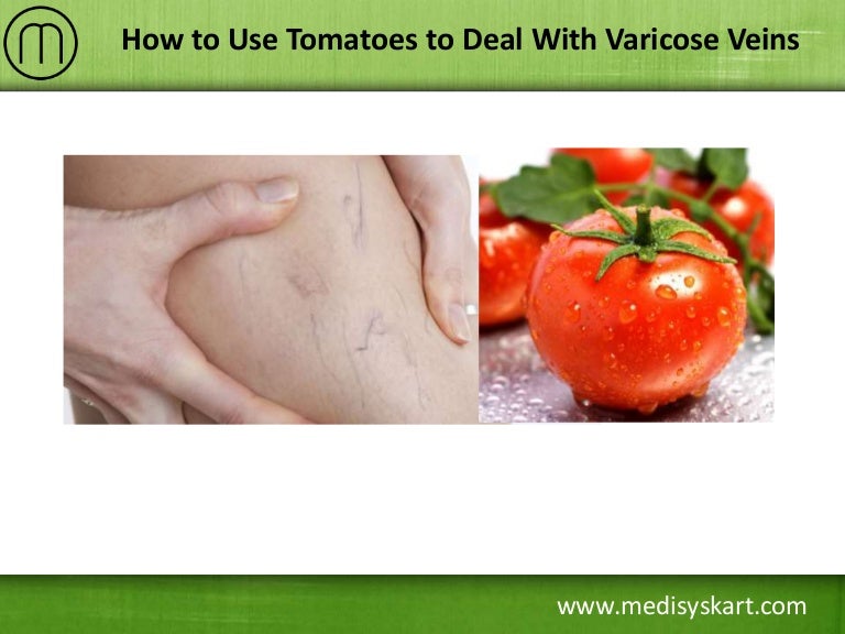 How to Use Tomatoes to Deal With Varicose Veins