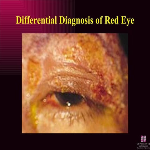 Differential Diagnosis of Red Eye