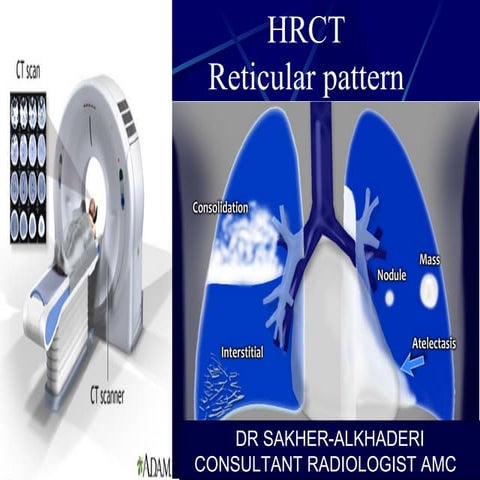 HRCT Reticular pattern 