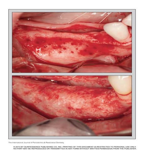 H ridge augmentation with a collagen membrane and combination of particulated...