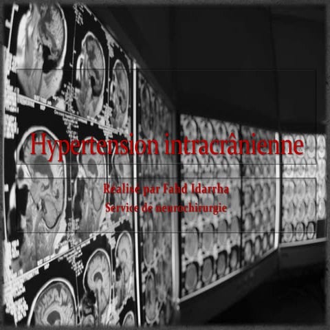 HTIC - Hypertension intracrânienne | PPTX