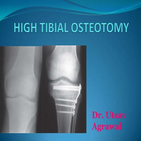High Tibial Osteotomy_UTSAV