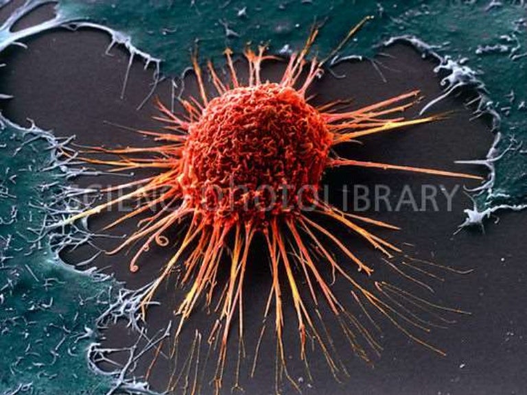 Human papilloma virus in oropharyngeal cancers