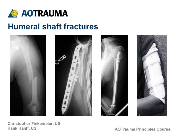 Humeral Shaft