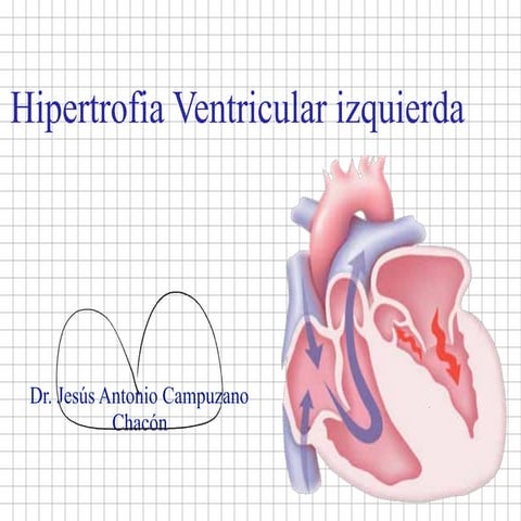 Hipertrofia ventricular izq
