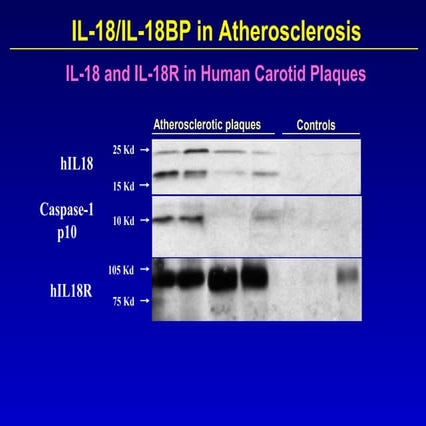 092 il18 and il18 bp in atherosclerosis