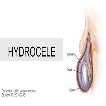 Hydrocele types and examination and management | PPTX