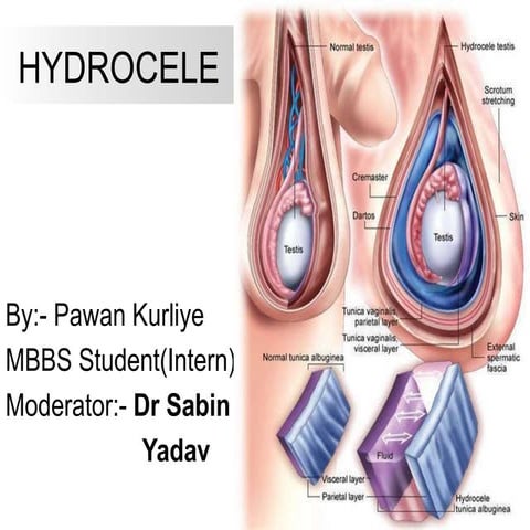 Hydrocele- All types & treatment options