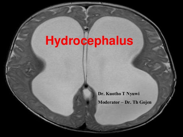 Types Of Hydrocephalus