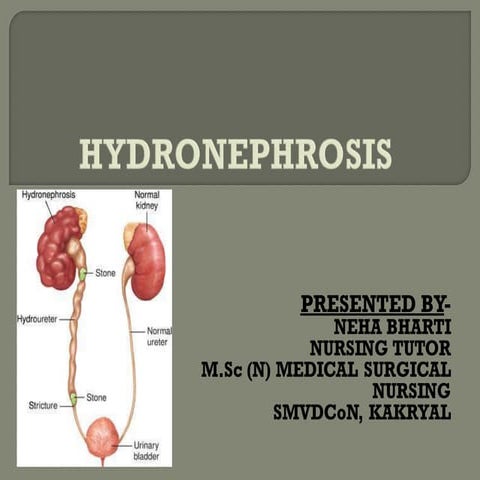 Hydronephrosis