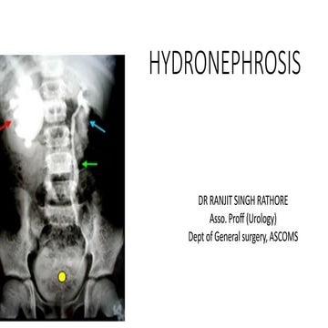 HYDRONEPHROSIS  clinical evaluation and management - DR RANJIT.pptx
