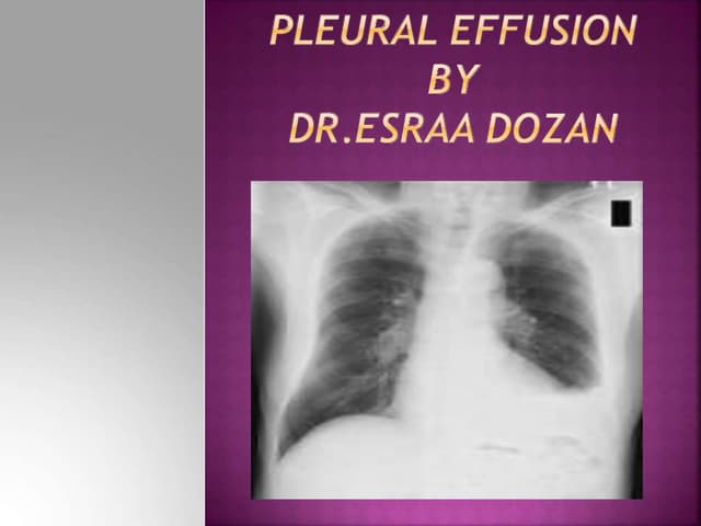 hydrothorax presentation.pptx