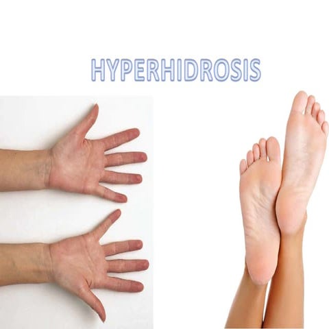 Hyperhydrosis 2