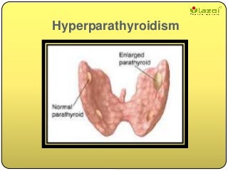 hyperparathyroidism lifecare lazoi