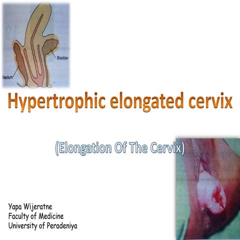 Hypertrophic elongated cervix (elongation of cervix)