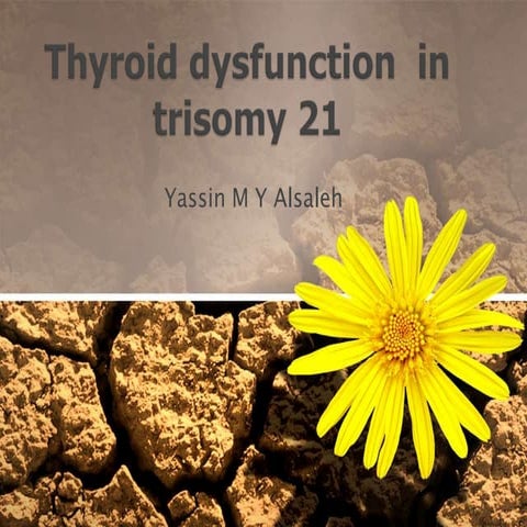 hypothyrodsim in trisomy 21