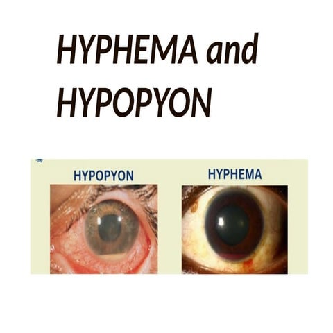 hypopyon vs ................hyphema.pptx