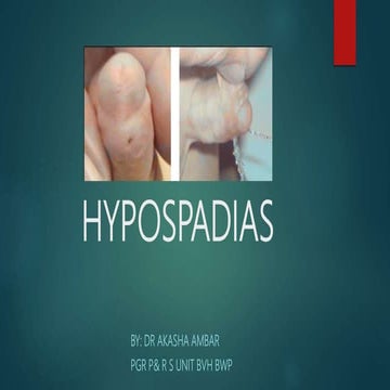 Hypospadias 3: MAGPI & snod grass (TIP) step by step operative urology