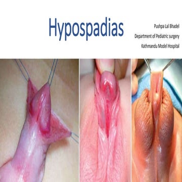 pediatric genitalia1 Hypospadias.pptx
