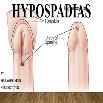 Hypospadias.pptx
