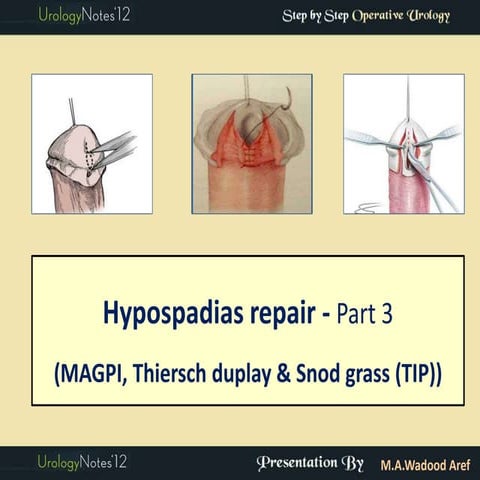 Hypospadias 3: MAGPI & snod grass (TIP)   step by step operative urology series 